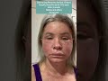 Day by day progression after facelift, C02, lip lift and browlift with before and after photos.