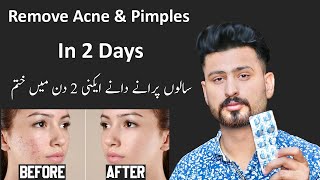 Best Treatment For Remove Pimple & Acne In 2 Days | Pimples Removal Permanent On Face at Home screenshot 3