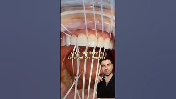 Flossing After Cementing Veneers