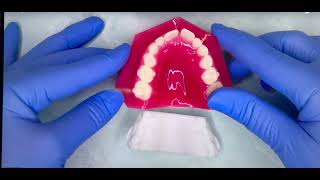Invisalign Palatal Expander