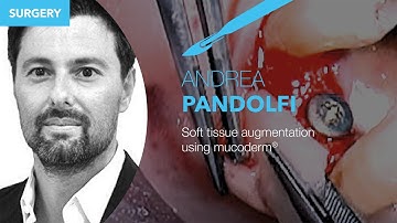 Soft tissue augmentation using mucoderm® - live surgery by Dr. A. Pandolfi