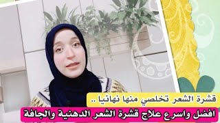 قشرة الشعر تخلصي منها نهائيا | وصفة رهيبة في القضاء على القشرة وعلاج التهابات فروة الرأس