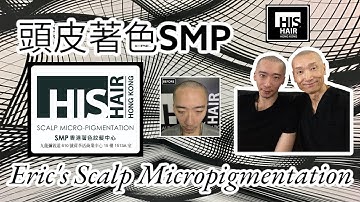 Scalp Micropigmentation interview with Eric, who restored his hair loss with 的頭皮著色紋髮(SMP)