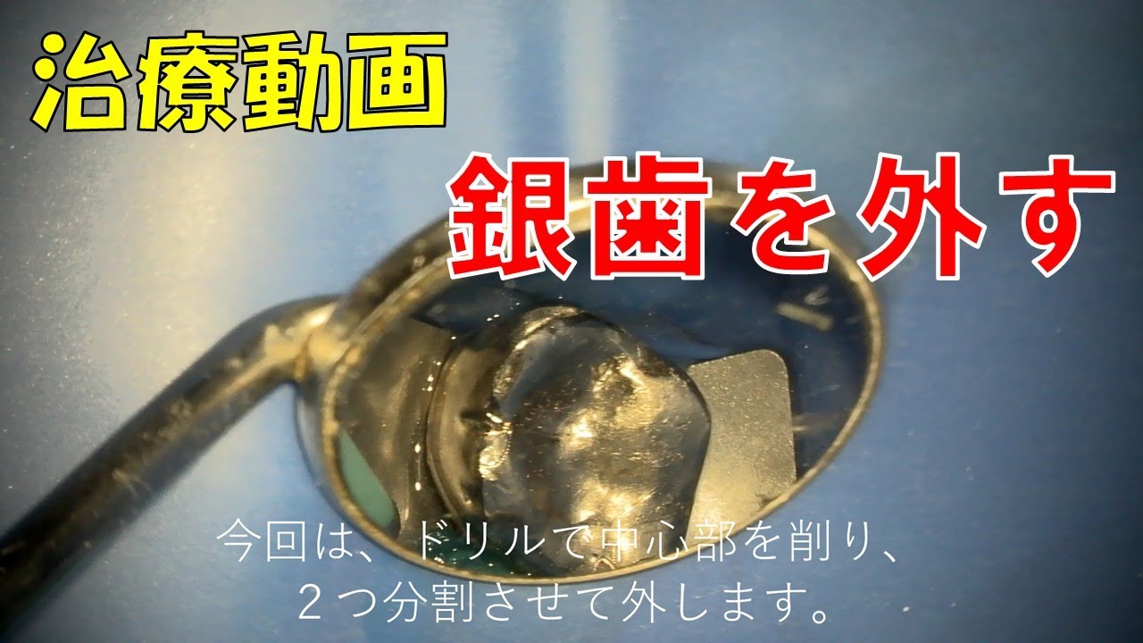 銀 歯 外す