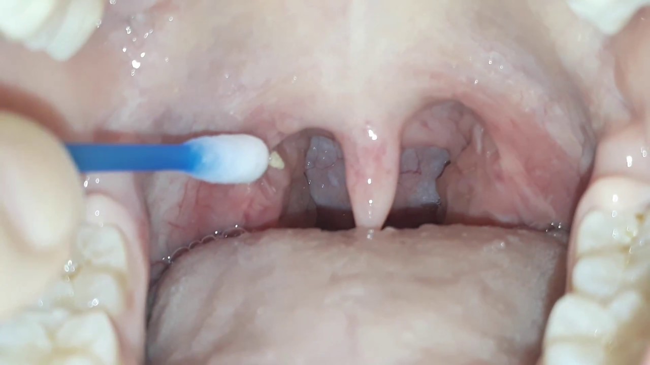 Tonsil Stone Removal Youtube