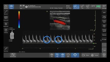 Venue Family Tutorials: Pulse Wave Doppler Optimization