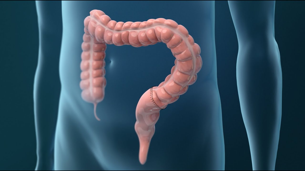 Treatments for Colorectal Cancer YouTube
