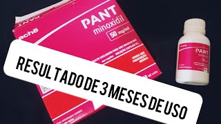 MINHA EXPERIÊNCIA COM MINOXIDIL PANT