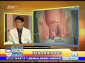 Usapang Pangkalusugan - Hemorrhoids (July 2)