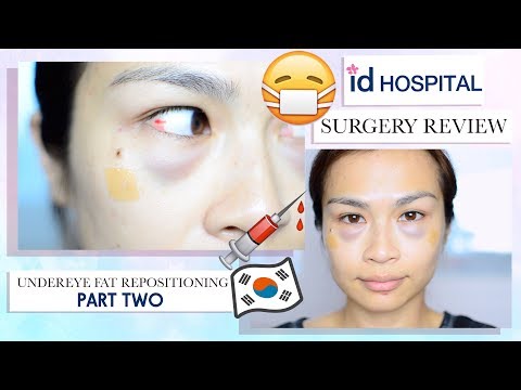 My Plastic Surgery Experience in Korea (Part 2)⎮Under Eye Fat Re-positioning/ Eye Bag Removal