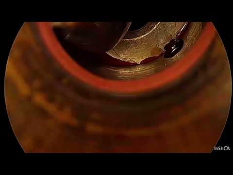 LAPAROSCOPIC HEPATICOJEJUNOSTOMY FOR CHOLEDOCHAL CYST