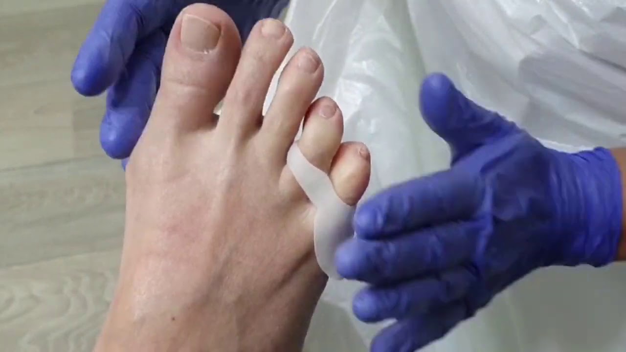 Pedisil Teenspreider Bunionette 2 Tenen (RPSIL0 0005)