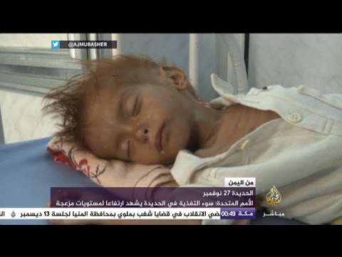 سوء التغذية ينهش أجساد 1.5 مليون طفل يمني