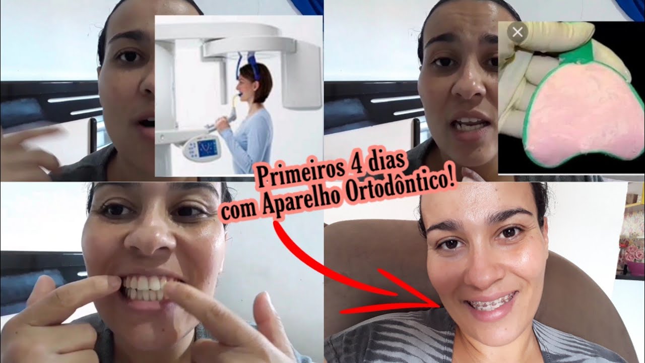 aparelho ortodôntico- documentos- montagem- dor- fome-  1ºs 4 dias