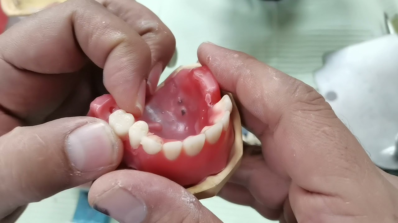 Arrangements of upper posterior complete dentur