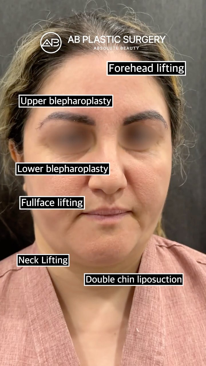 Why Korean Facelifting Works So Well #shorts