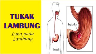 Gastric Ulcer, Definition, Symptoms, Causes, Treatment and Prevention