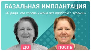 Базальная имплантация – отзывы: реальный пациент рассказывает о лечении