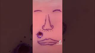 Crescentic advancement flap (part 1)