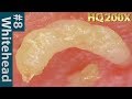 👃#8 Squeezing Whiteheads Close up HQ200 | にゅるにゅる角栓を押し出し除去
