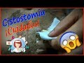 😱 Cuidados en casa | CISTOSTOMIA – Uretroplastia – Cistorrafia | Paso a Paso Accidente de Transito