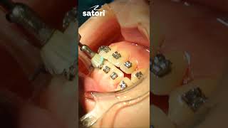 Профессиональная чистка зубов с брекетами #брекеты #braces