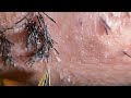 Plucking facial hair & ingrown hair 973 顎髭抜き(埋没毛あり)