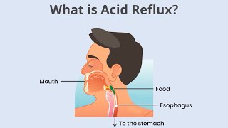 Famous Understanding acid reflux and GERD: What you need to know Wealth