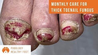 Monthly for THICK TOENAIL FUNGUS under SUPER ZOOM ***asmr podologia***