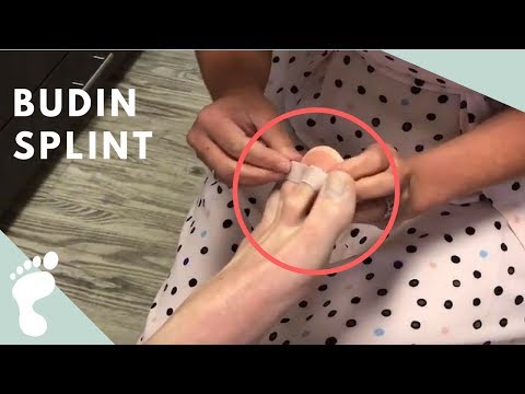 Video: Hammer Toe Splint Typer Og Fordeler