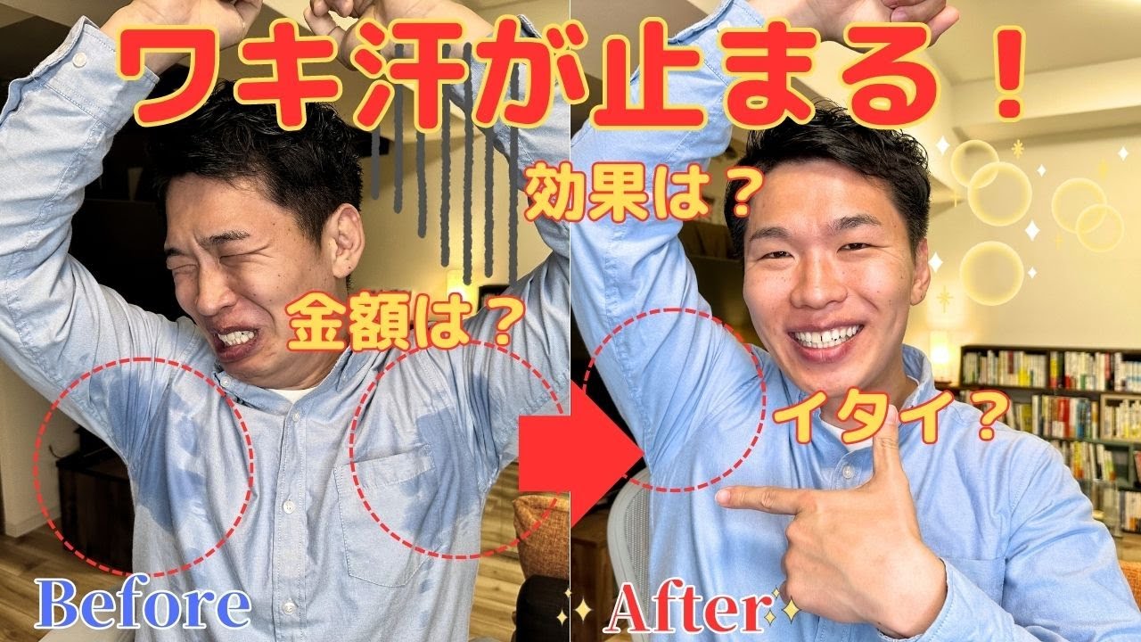 【ワキ汗が止まる】「ワキのボトックス」とは？【服代も節約💰】 ※詳細は概要欄も見てください🙆