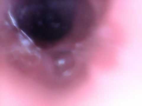 Vore Endoscope