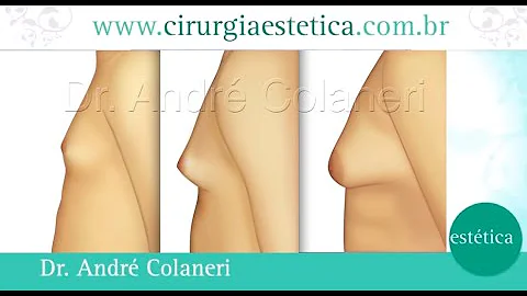 Como saber se você está com ginecomastia?