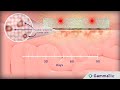 Patient Resource: How GammaTile Works