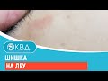 ➡ Шишка на лбу. Клинический случай №921