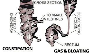 LAXATIVES vs COLON HYDROTHERAPY (Healthy Solutions) Listen To This SUBSCRIBE & HIT ALL ON BELL.