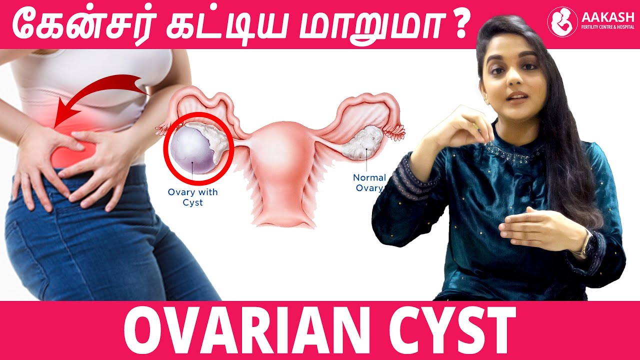 Ovarian Cyst சினைப்பை கட்டிகள் | Aakash Fertility Centre & Hospital