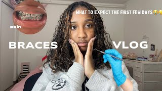 I Got Braces My Experience What To Expect Very Painful