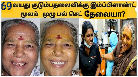 இம்பிளாண்ட் மூலம் முழு பல் செட்- எத்தனை நாட்கள் ஆகும்?/ fixed full teeth dental implants!