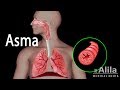 Patología del Asma, Animación. Alila Medical Media Español.
