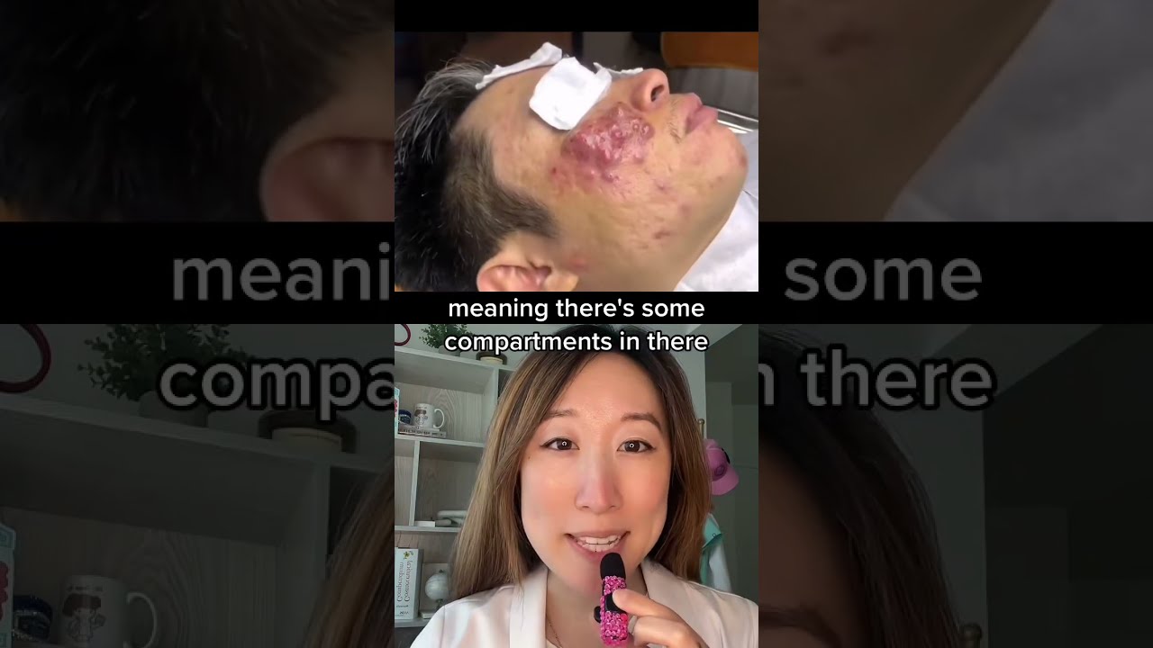 Extracting A Nodulocystic Acne Plaque Hope They Numbed First Dermbypark Shorts