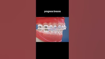 Quy trình niềng răng khớp cắn hở #nhakhoadrsoan #niengrang #braces #shorts