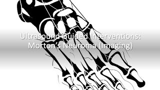 Ultrasound Imaging of Morton’s Neuroma | Foot Pain Diagnosis