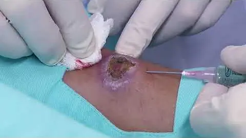 Como que é a ferida da leishmaniose?