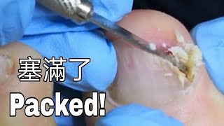 Packed Ingrown toenails dug out 甲溝炎治療 염증과 고름 가득한 내성발톱 치료