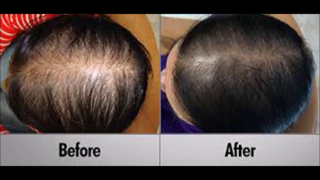 Onion Juice For Hair Regrowth - How To Use In Hindi How Often Should I