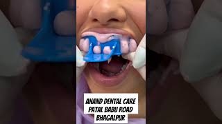 Alginate Impression Taking Neat And Clean Alginate Impression Taking