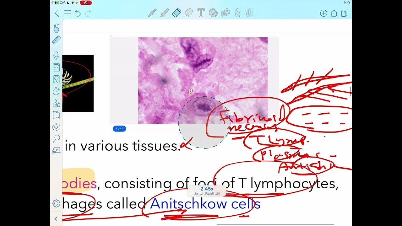 Pathology : Rheumatic heart disease part 2