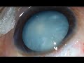 Intumescent white cataract in a young patient management unedited