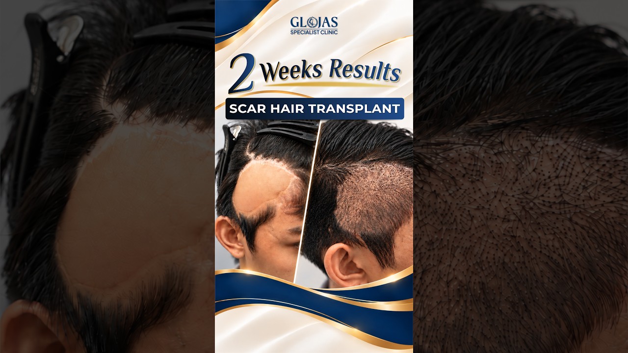 Our Doctors 12 Hair Transplant Malaysia l 2 weeks post scar hair transplant! 🌱✨ #hairtransplantmalaysia
